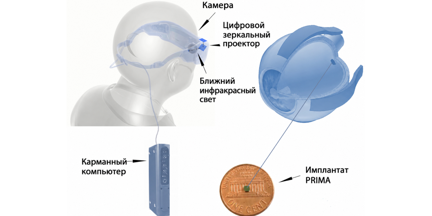 Миниатюрный ретинальный имплант PRIMA, который преобразует световой сигнал в электрическую стимуляцию сетчатки.